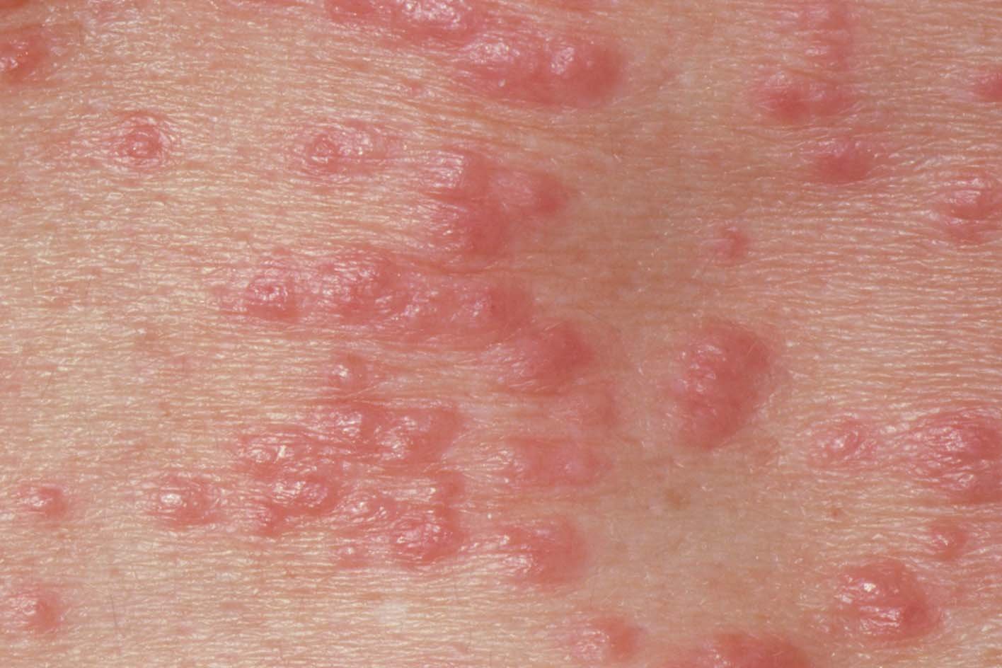 https://www.tewv.nhs.uk/content/uploads/2022/04/Scabies-image-from-NHS-England.jpg