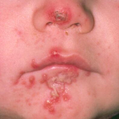 Impetigo